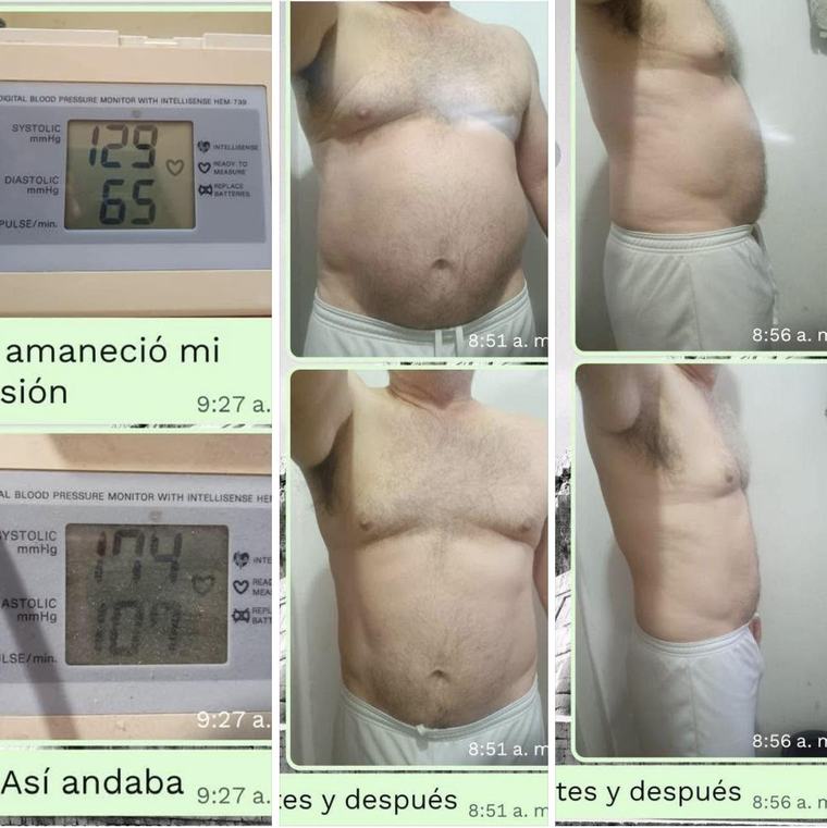 Registro real de presi&oacute;n arterial, antes y despu&eacute;s